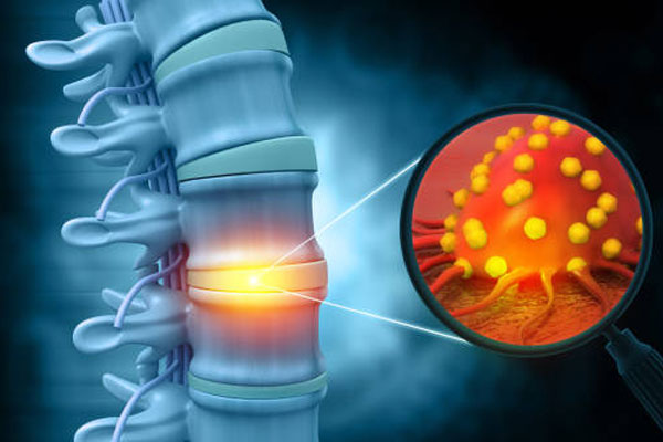 Bone Cancer