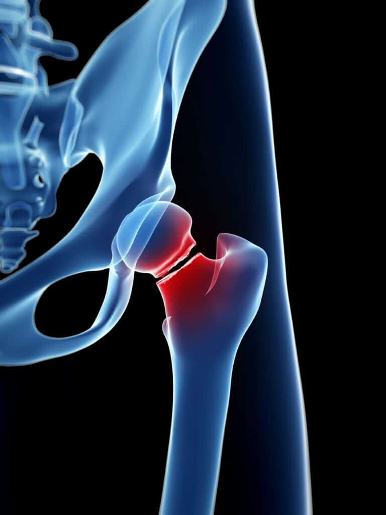 Fracture Management